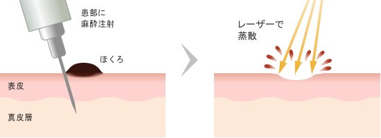 ウルトラパルス CO2 レーザー