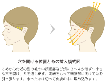 穴を開ける位置と糸の挿入模式図